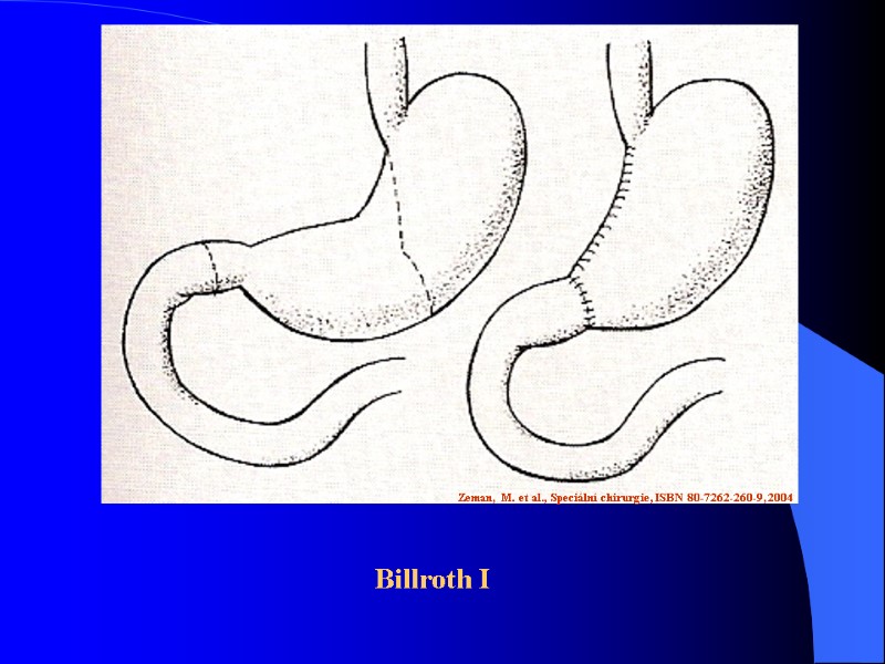 Zeman, M. et al., Speciální chirurgie, ISBN 80-7262-260-9, 2004 Billroth I